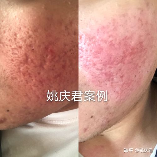 严重痘坑一期治疗