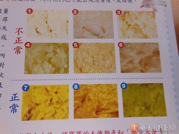 黄疸和大便颜色异常是判断胆道闭锁的重要依据.