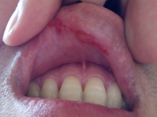 嘴唇内侧,红肿