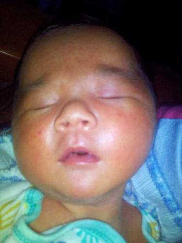 还是奶藓?还是胎毒?还是什么?