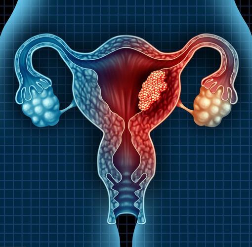 五,宫颈上皮内瘤样病变→宫颈癌