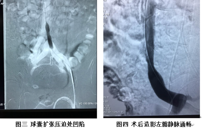 血管外科成功完成院首例髂静脉压迫综合征球囊扩张支架成形术