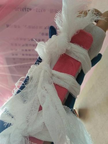 我在工地上干活,手臂摔骨折了,如果公司不处理,该怎么