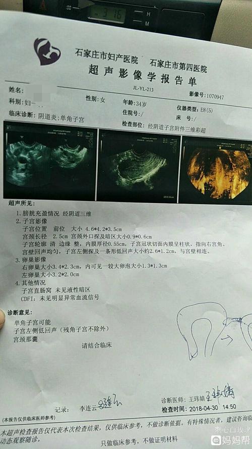 单角子宫?输卵管峡部闭塞!