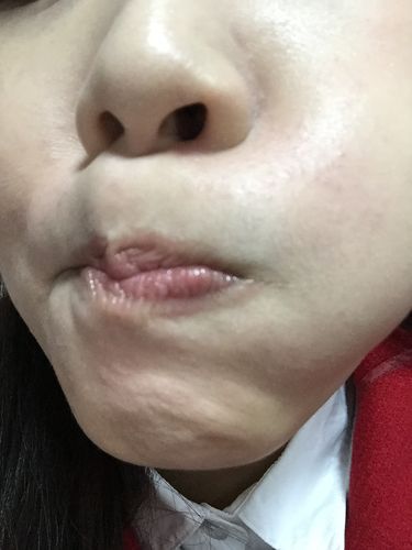 下巴起红点到底是怎么回事