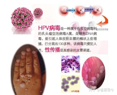 hpv感染,还不懂的女性朋友看过来,不要慌,这些关于hpv的知识是你需要