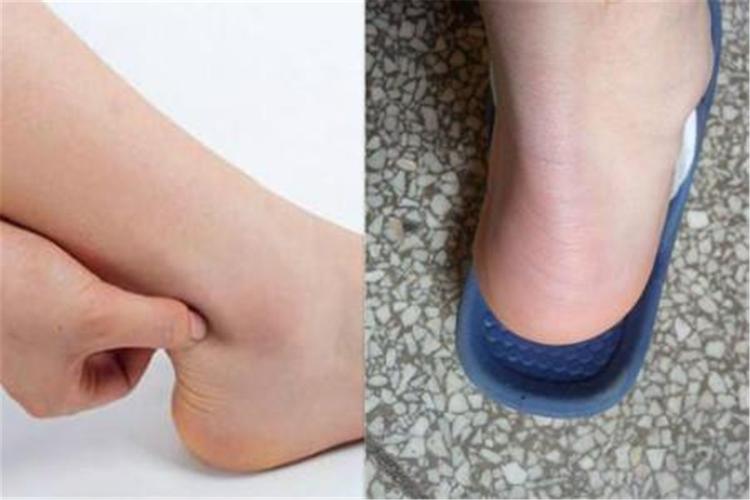 脚上长有3个"标记",或许是说你肾好,若你也是,值得