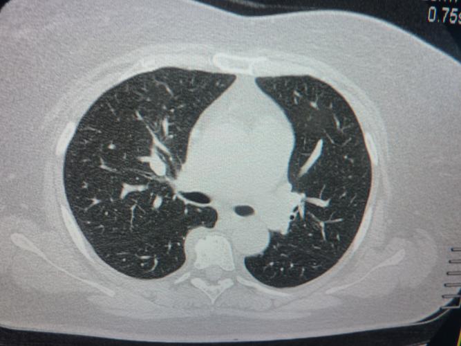 ct52812右肺门旁是血管影