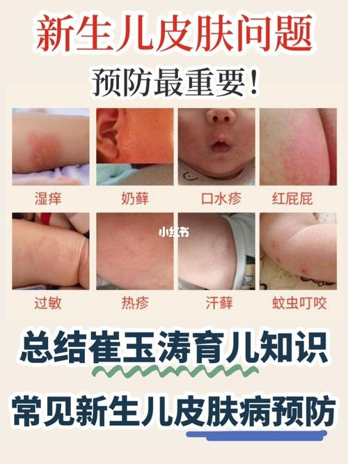 总结常见86615种新生儿皮肤问题_皮肤病_新生儿_皮肤问题_蚊虫_纸