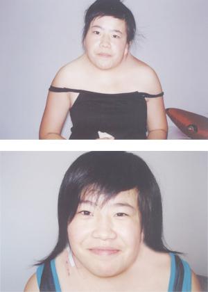 展开全部 (1) 面颈部畸形:小颌畸形,内眦赘皮,发际低平,颈蹼(约 50 %