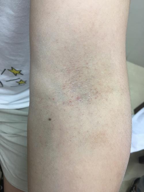 (发生于成人期的特异性皮炎)