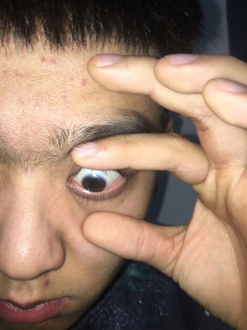 我的眼睛黑眼仁边缘不清晰 有白色情况 是怎么回事啊?