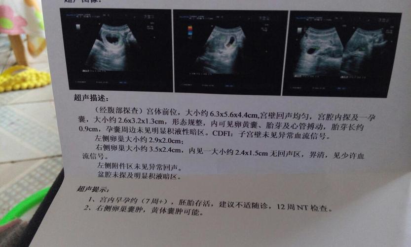 孕八周b超,图片看男女宝宝?