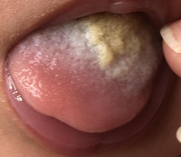 病情描述: 舌苔发黄发厚,纯母乳喂养,吃拉正常,怎么调理?