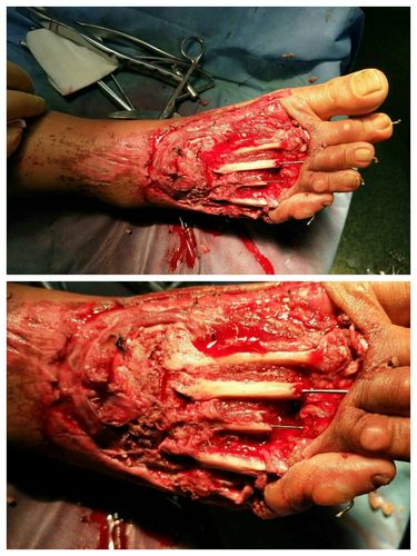 术中清创,内固定术后,骨质缺损外露,皮肤,软组织,肌腱缺损.