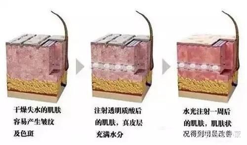 注射水光针有什么危害吗?术后面部表情僵硬,凹凸不平怎么办?