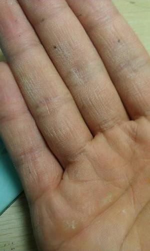 这是什么类的手藓,如何用药,还望高告之.