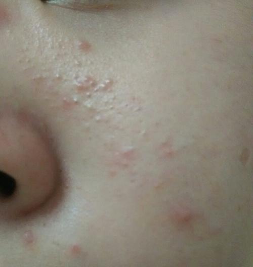 不知道脸上长的这是什么,是不是螨虫?怎么才会没有?