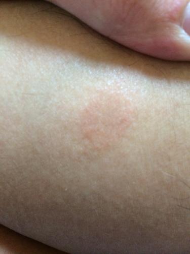 问:腿上有点小红疹子的感觉 不疼不痒 外圈红内圈发乌 是什么病?