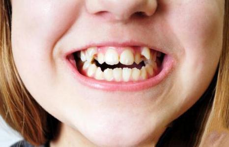 儿童牙齿不齐矫正的最佳年龄