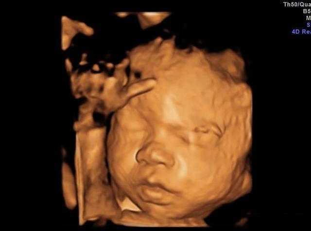 怀孕24周,这项检查重要又"难过",还必须做,孕妈要提前了解