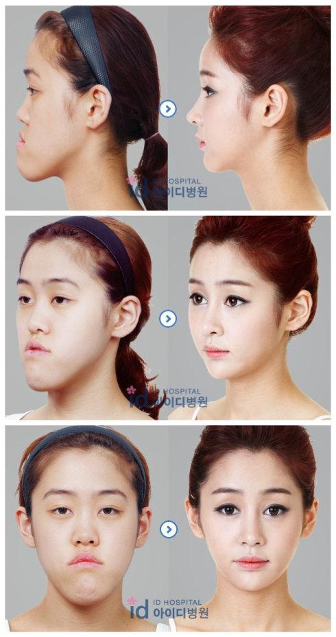 突嘴手术矫正"地包天"