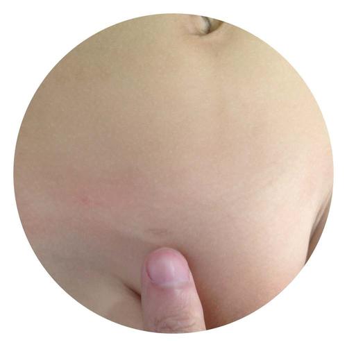 少年儿童腹股沟疝气大专