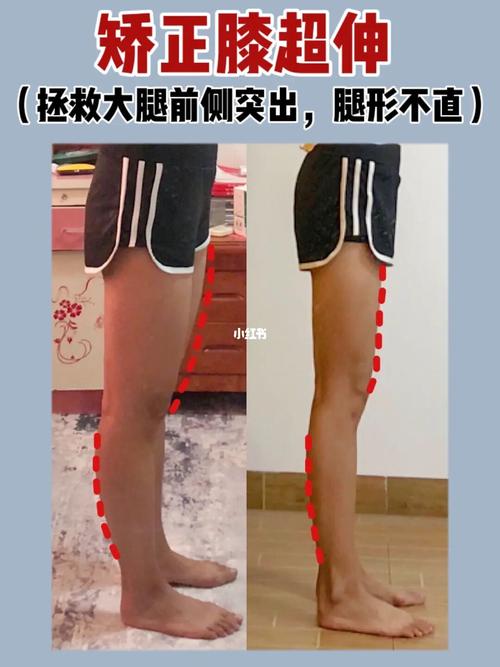 矫正膝超伸7515拯救大腿前侧突出,腿形不直～_筋膜枪_瘦小腿_瘦