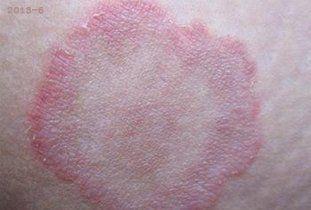 夏季常见"皮肤病"治疗大全,收藏备用!