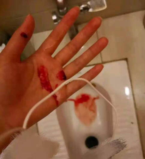 我没敢承认;近几个月我经常流鼻血,一吐就流,我