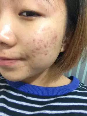 显微镜下的痘痘,一个痘痘200条虫!长痘必看.