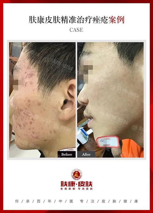 有面部痤疮怎么治?|维a酸|皮损|治疗_网易订阅