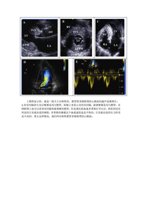 超声心动图在肥厚型心肌病中的应用.pdf 10页