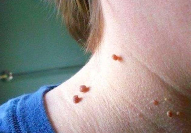 为常见,我们俗称"瘊子"的这种问题,其实是一种病毒感染引起的皮肤问题