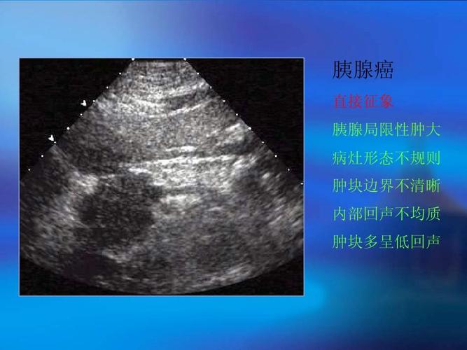 胰腺超声诊断ppt