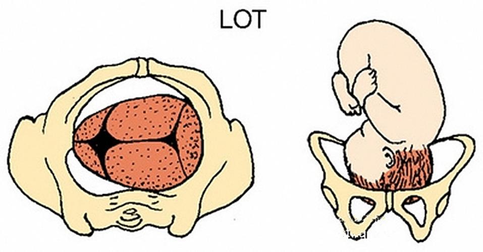 胎方位怎么判断的图片