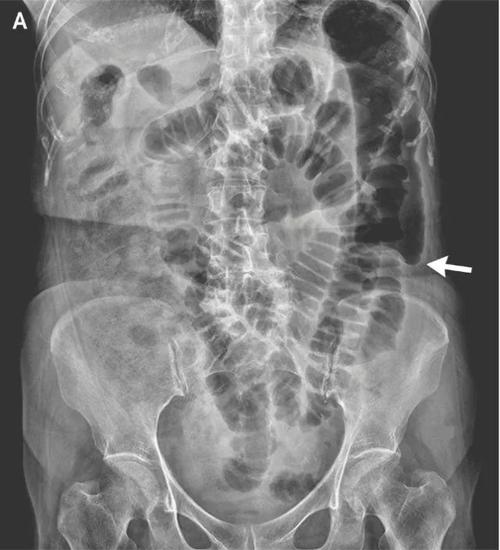 图 4 腹部x线平片结果显示降结肠截断(箭头所示),其上方肠道明显扩张