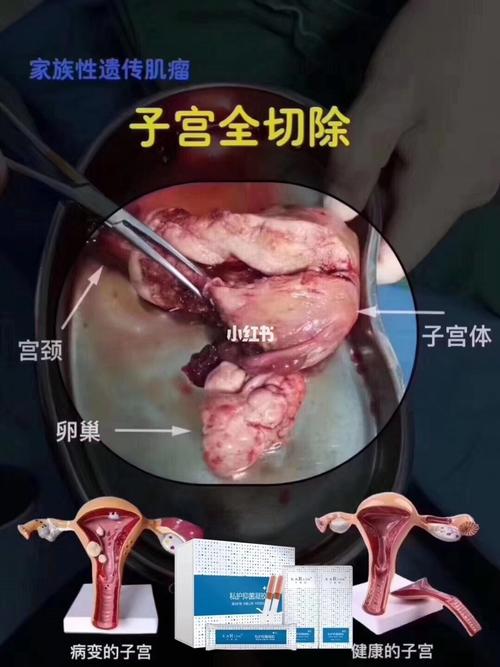 子宫切除_子宫_私护_凝胶_医疗健康_医疗健康其他