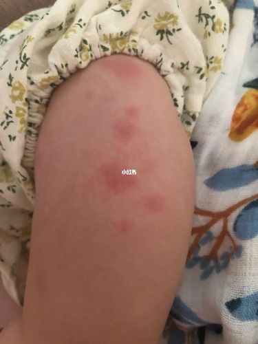 宝宝身上起的这个红疙瘩是啥?_皮肤问题_过敏_蚊帐