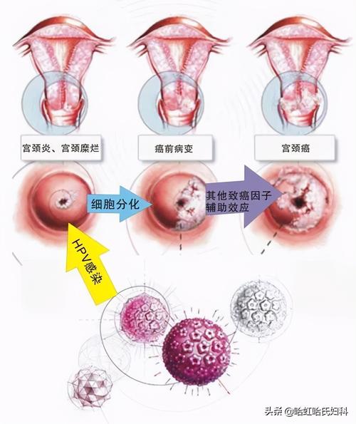 hpv是什么病80的人会感染hpv哪类属于高危