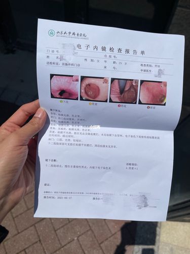 还愿贴 做了胃镜 胃炎_胃炎_小吃_健身_夜市_幽门螺旋