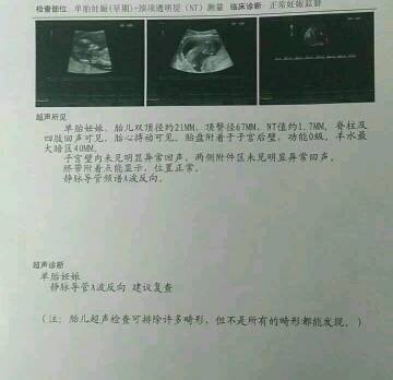 昨天做了nt,报告单上有说静脉导管a波反向,什麼意思啊