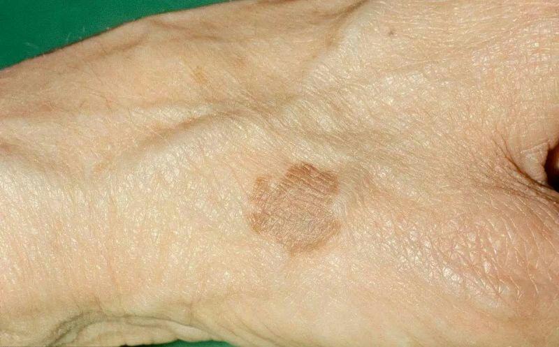 什么是脂溢性角化病