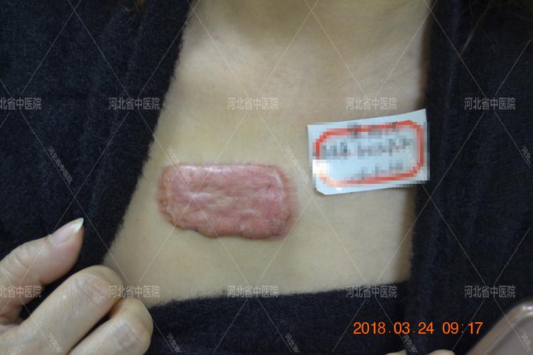 河北省中医院医疗美容科李秋霞主任:疤痕疙瘩患者案例