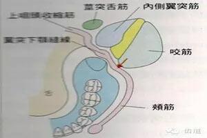 这是义齿后份,后方颊舌侧的解剖示意图