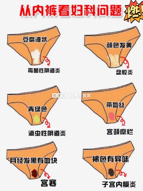 盆腔炎白带宫颈炎白带症状白带颜色自查妇科阴部颜色正常宫颈炎白带