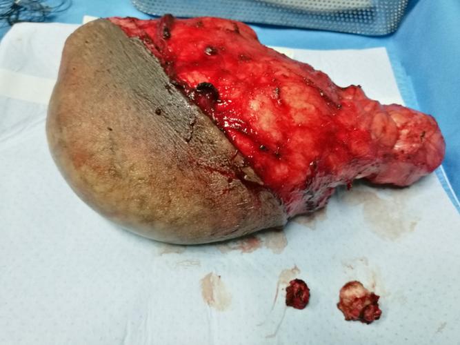 毛囊闭锁三联症之巨大阴囊病损切除