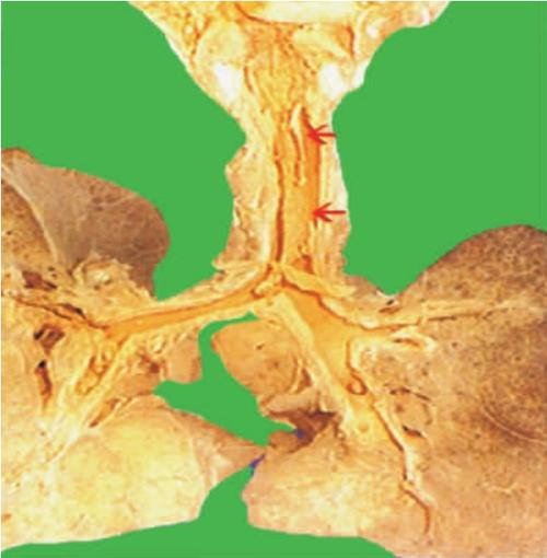 炎症的病理类型病理学