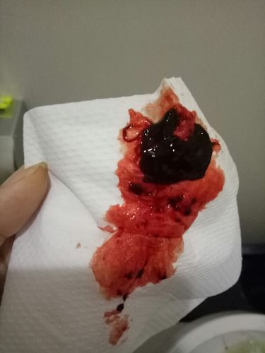 每次大姨妈一来一上厕所就出来好多这样的是血块吗跟肉一样