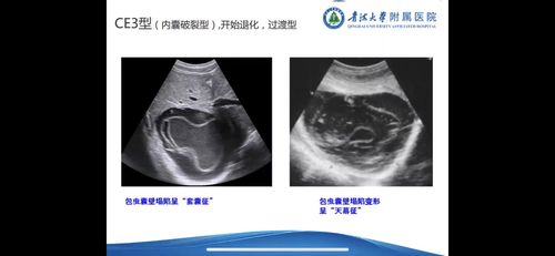 肝包虫病的超声分型与鉴别诊断